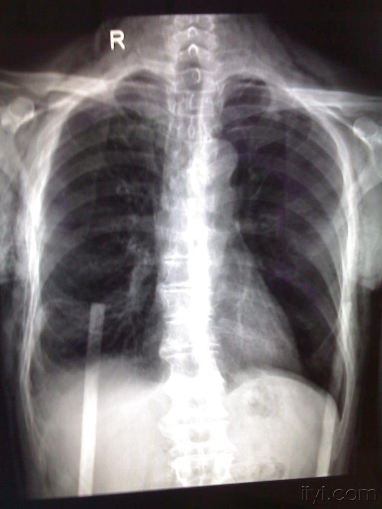 胸部外伤ct请教右下肺改变