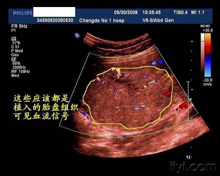 核磁共振胎盘植入图片图片