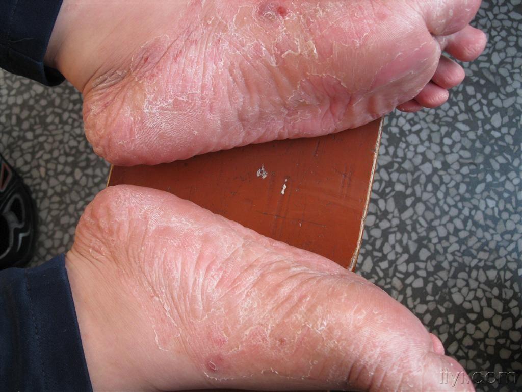 多发性真菌感染