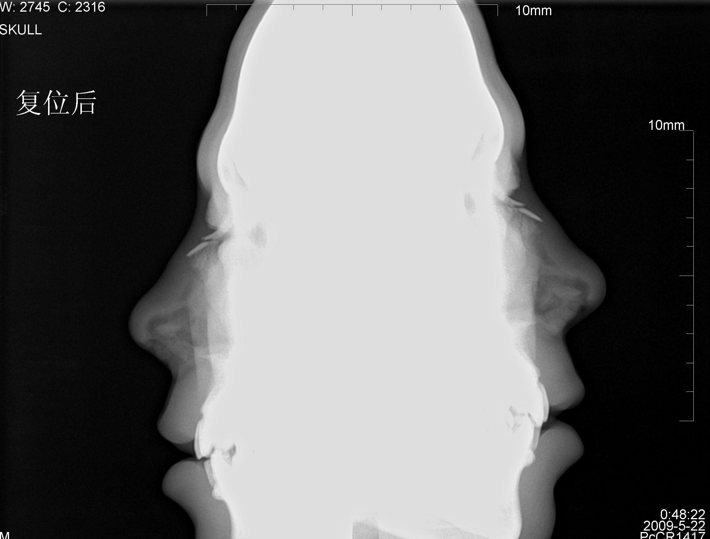 鼻骨正侧位x光片图片