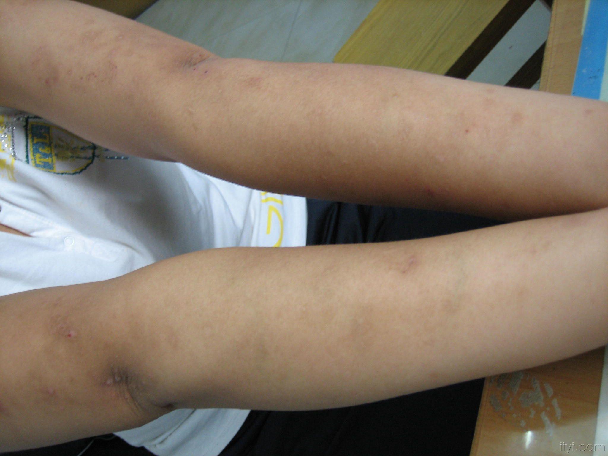 图片4多形性日光疹