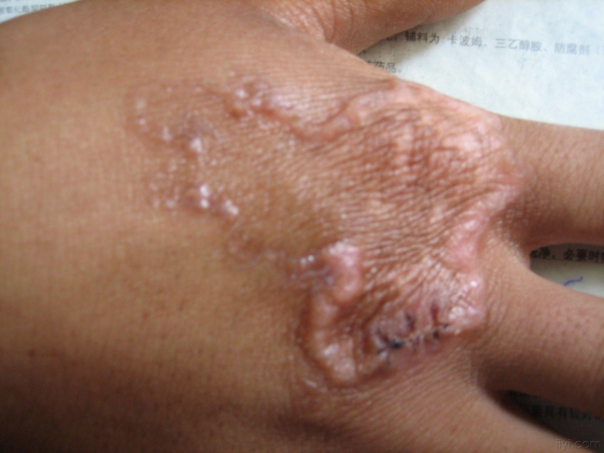 皮肤癣菌肉芽肿图片