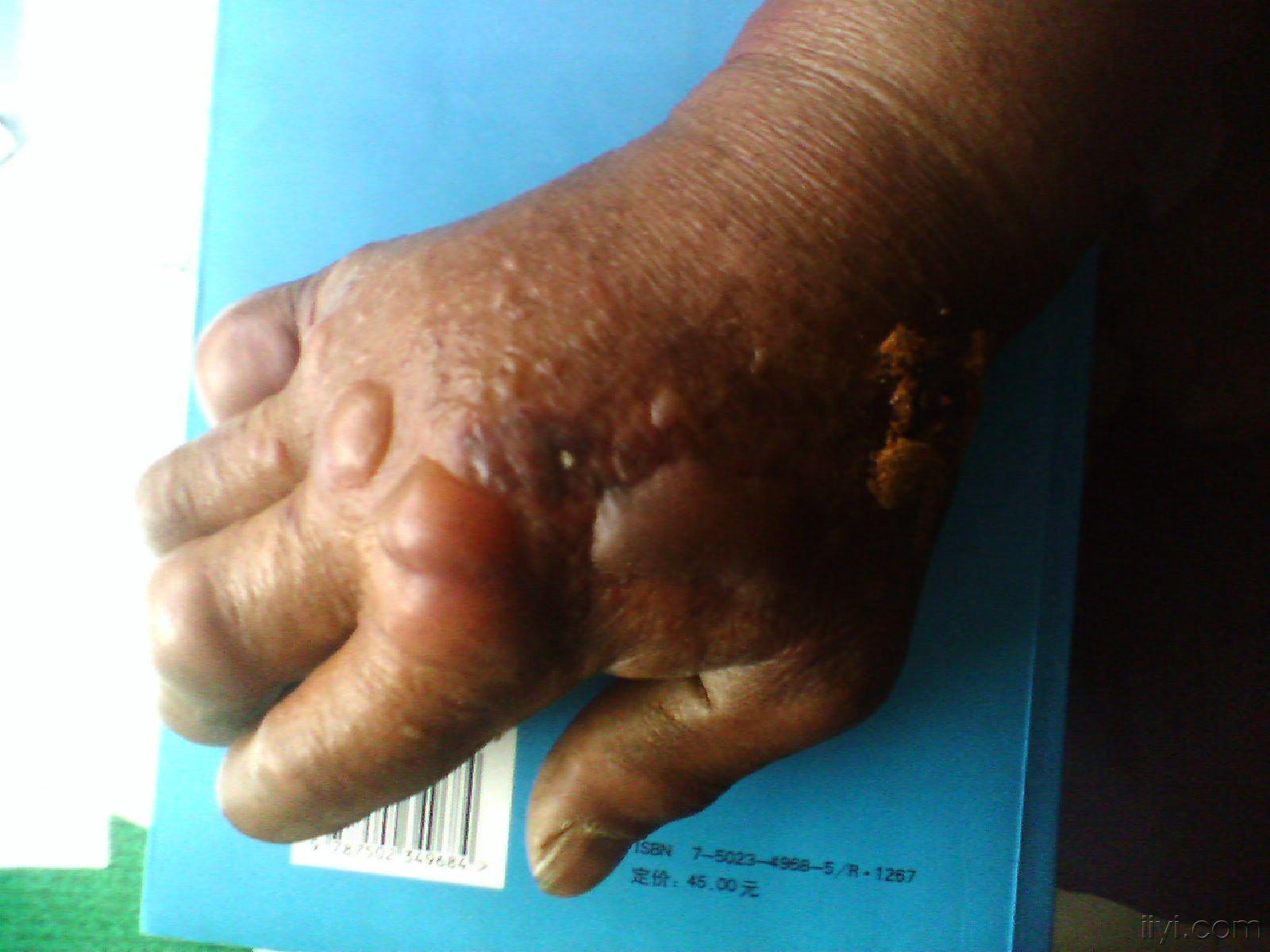 人感染皮肤炭疽病图片图片