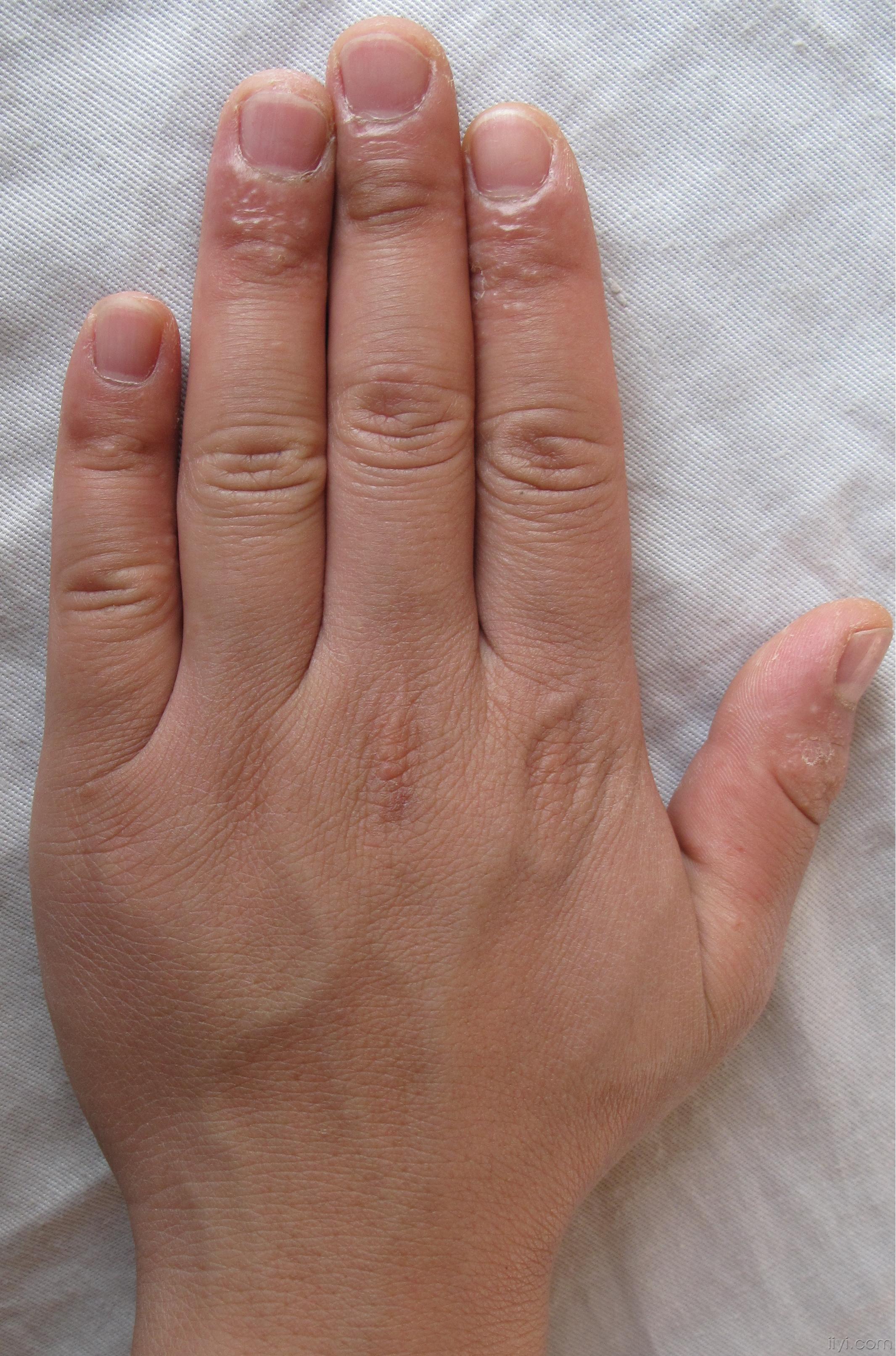 手病,痒. - 皮肤及性传播疾病讨论版 - 爱爱医医学论坛