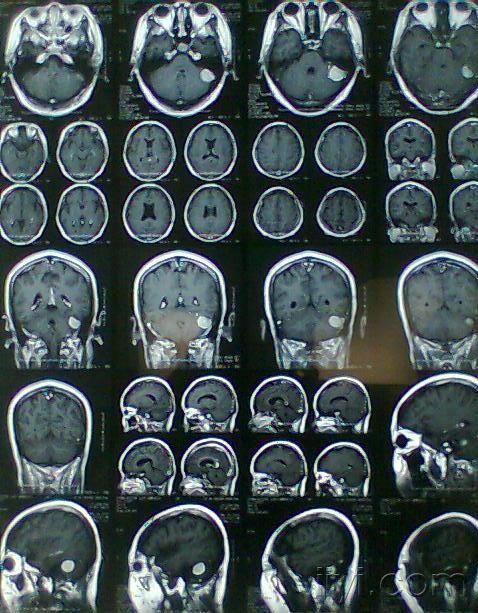 颅脑mr-典型病例,结果已公布-脑膜瘤.