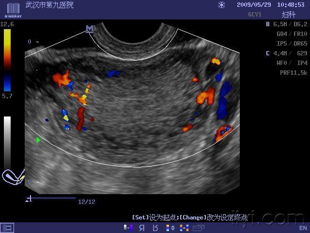 子宫肌层见条索状无回声区可见蛇形彩色血流