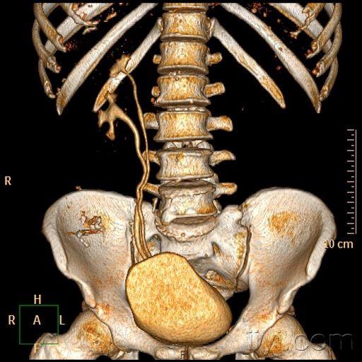 【原創】雙腎,輸尿管,膀胱,ctu