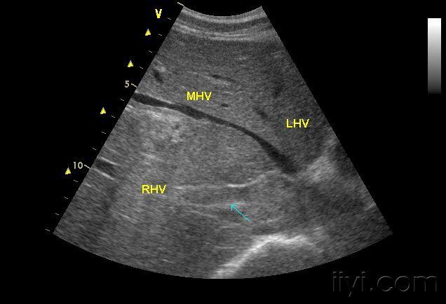 转移性肝癌超声图片图片
