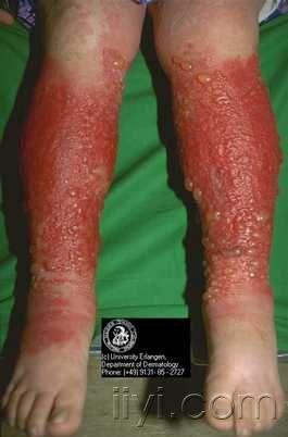 变态反应性接触性皮炎 - 皮肤及性传播疾病讨论版 - 爱爱医医学论坛