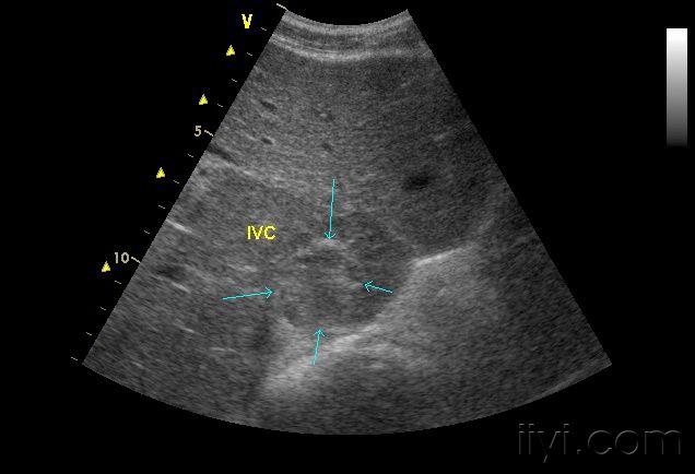转移性肝癌超声图片图片