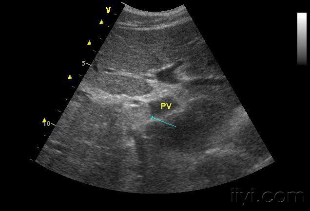 转移性肝癌超声图片图片