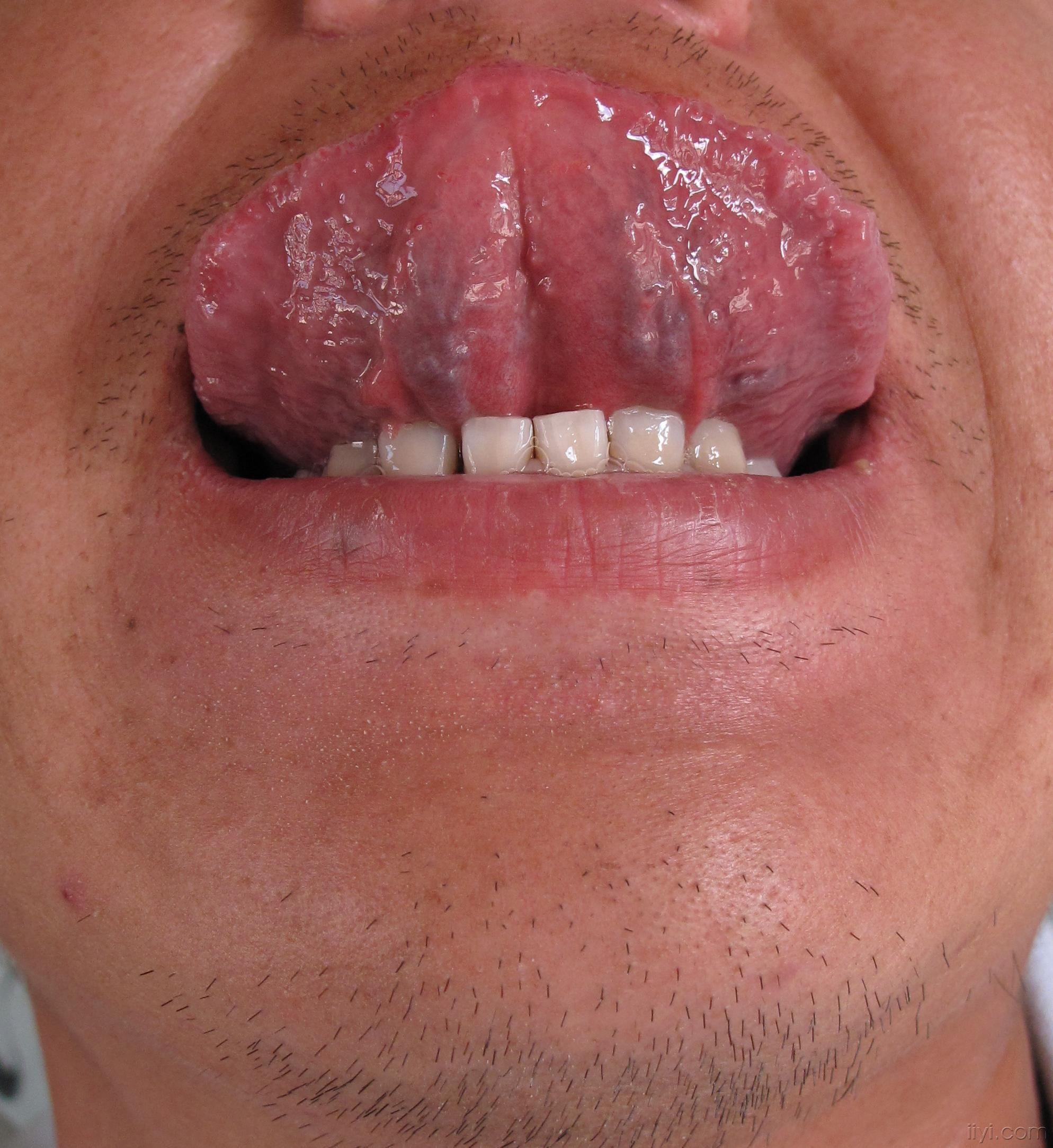一期梅毒图片舌头图片
