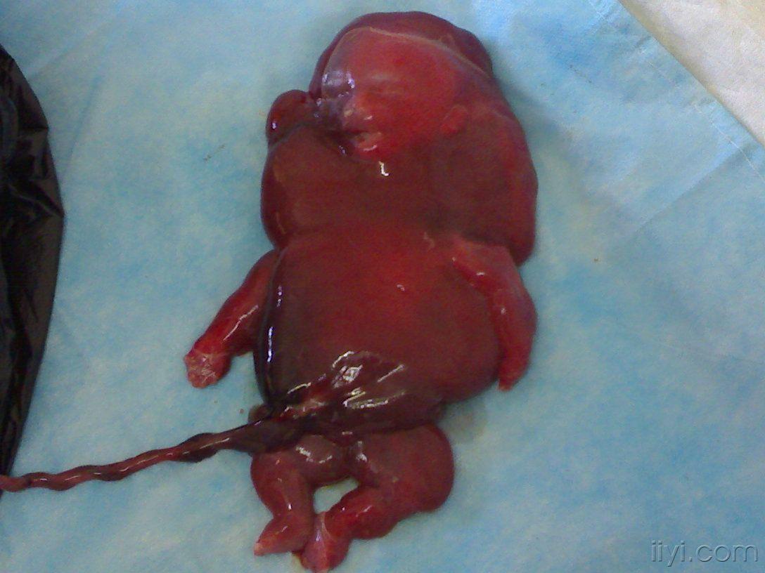 胎儿颈部淋巴管瘤图片图片