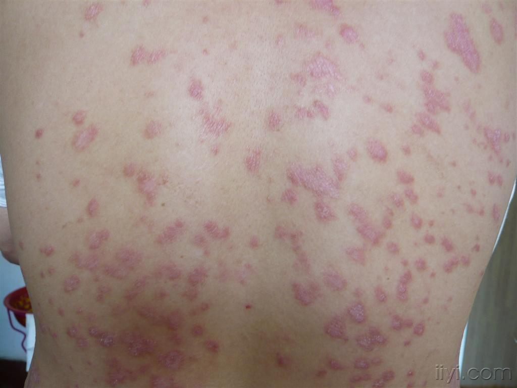 请大家帮忙诊治朋友身上的皮肤病有照片