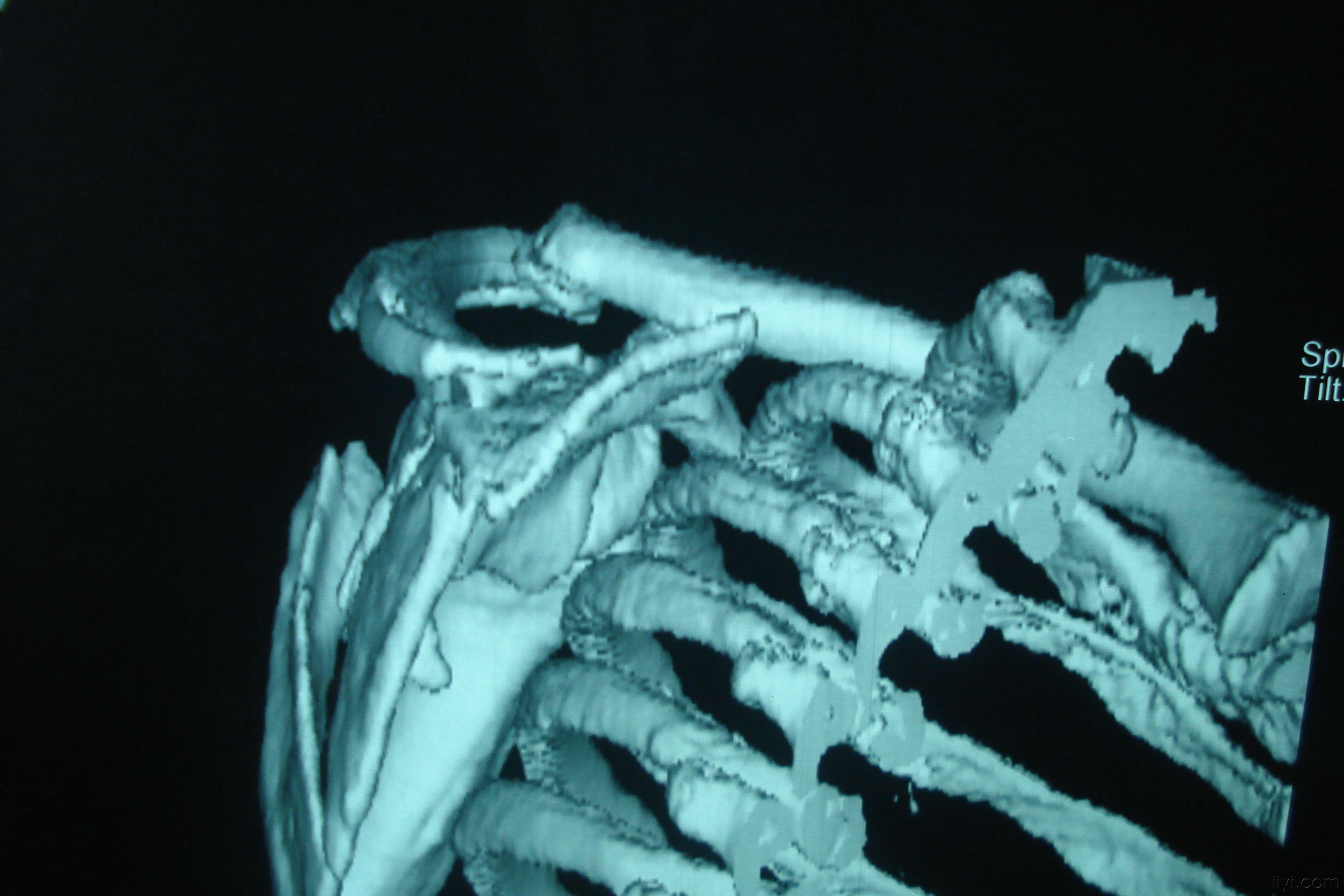 肩胛骨粉碎性骨折图片图片