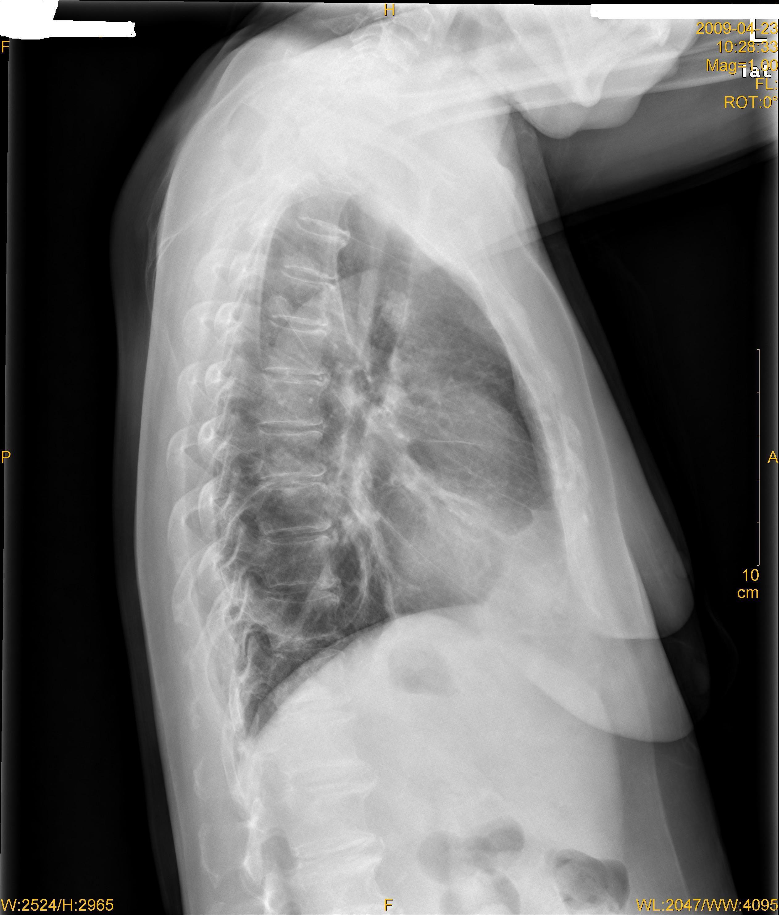 支气管囊肿x线表现图片