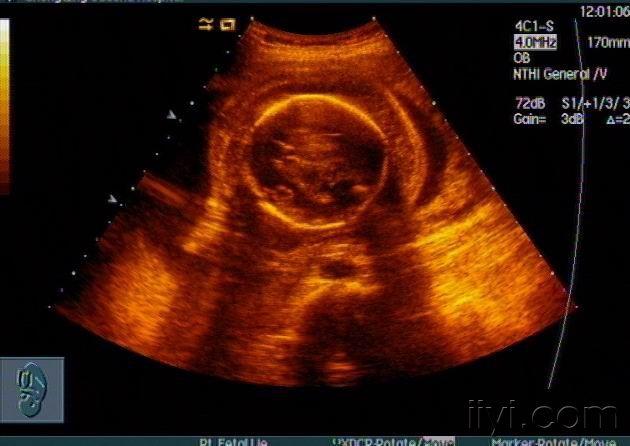 胎儿全身水肿并胸,腹腔积液声像图 