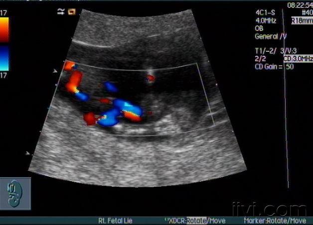 单脐动脉宝宝图片图片