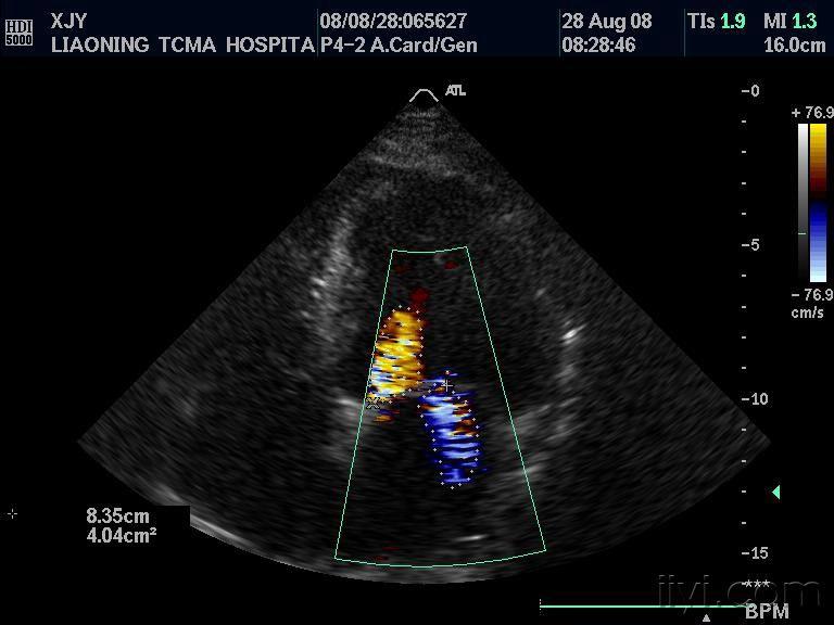主动脉瓣及二尖瓣同时反流 超声医学讨论版 爱爱医医学论坛