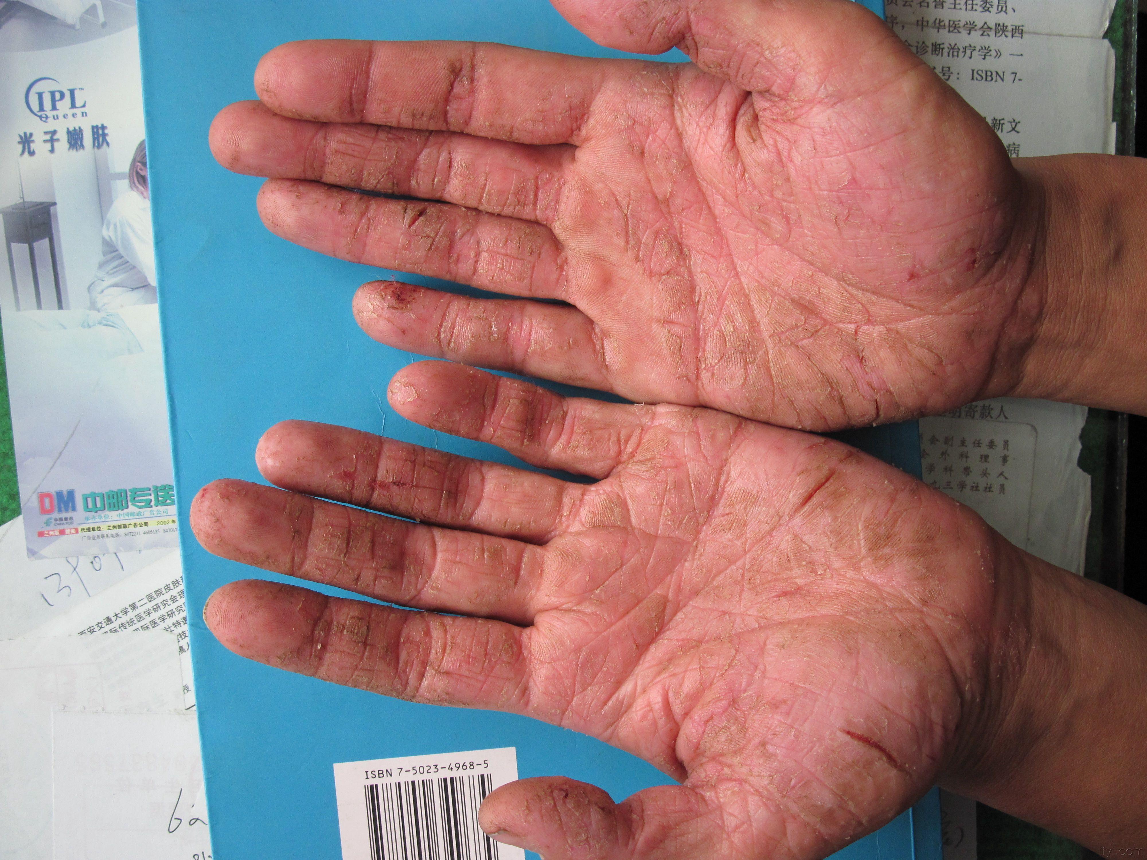 手指皲裂性湿疹图片图片