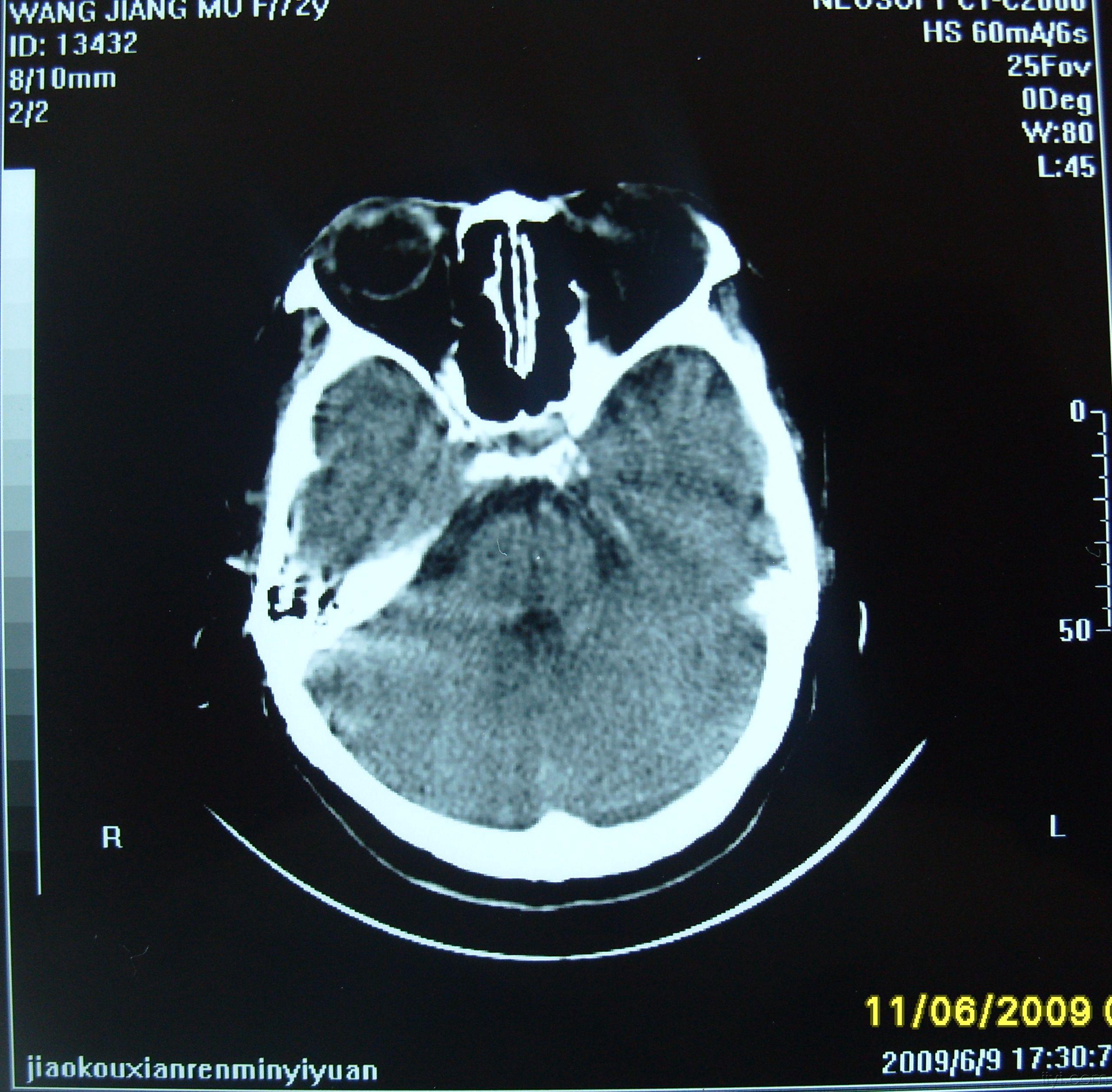 脑供血不足CT图片