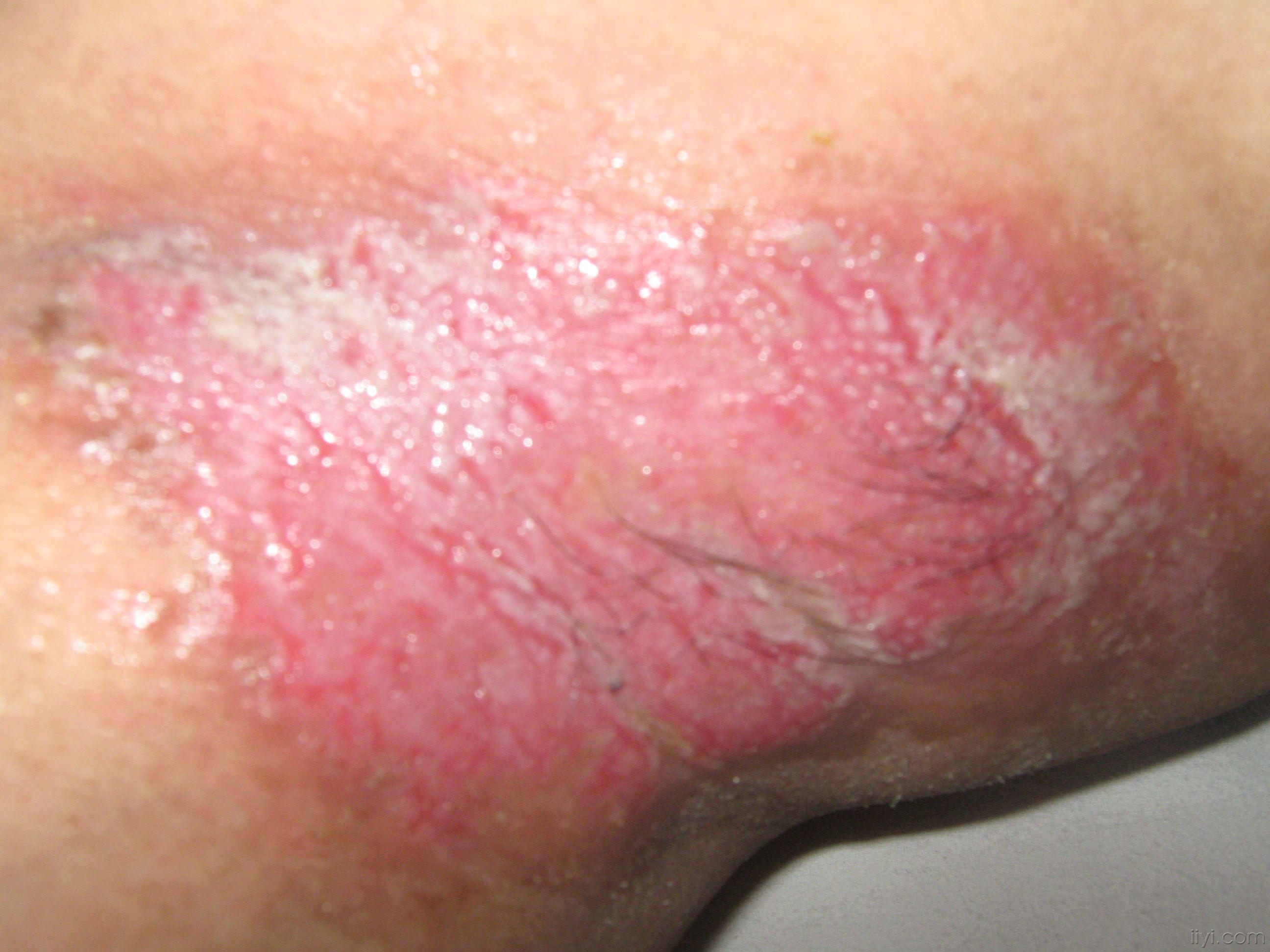 皮肤念珠菌的症状图片图片