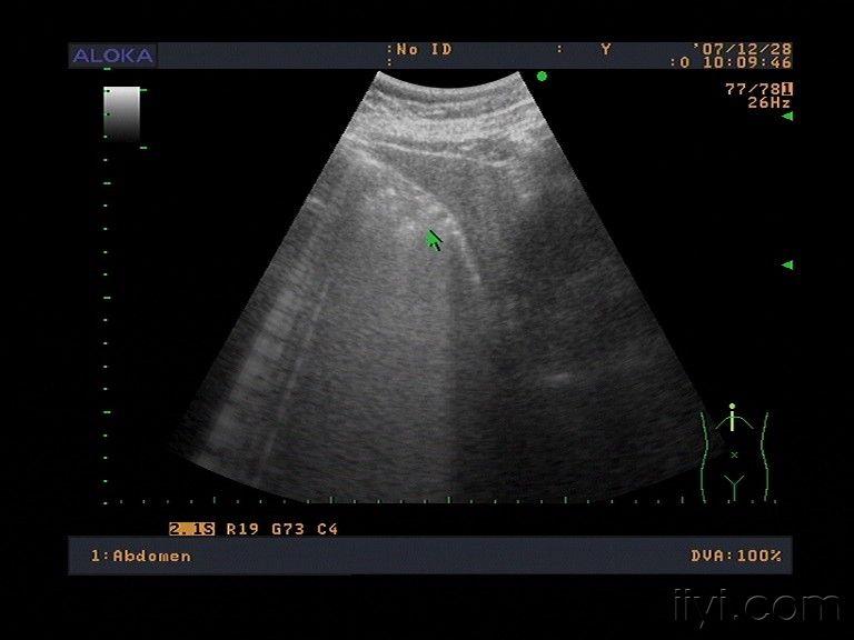 萎缩性胆囊炎胆结石 - 超声医学讨论版 - 爱爱医医学论坛