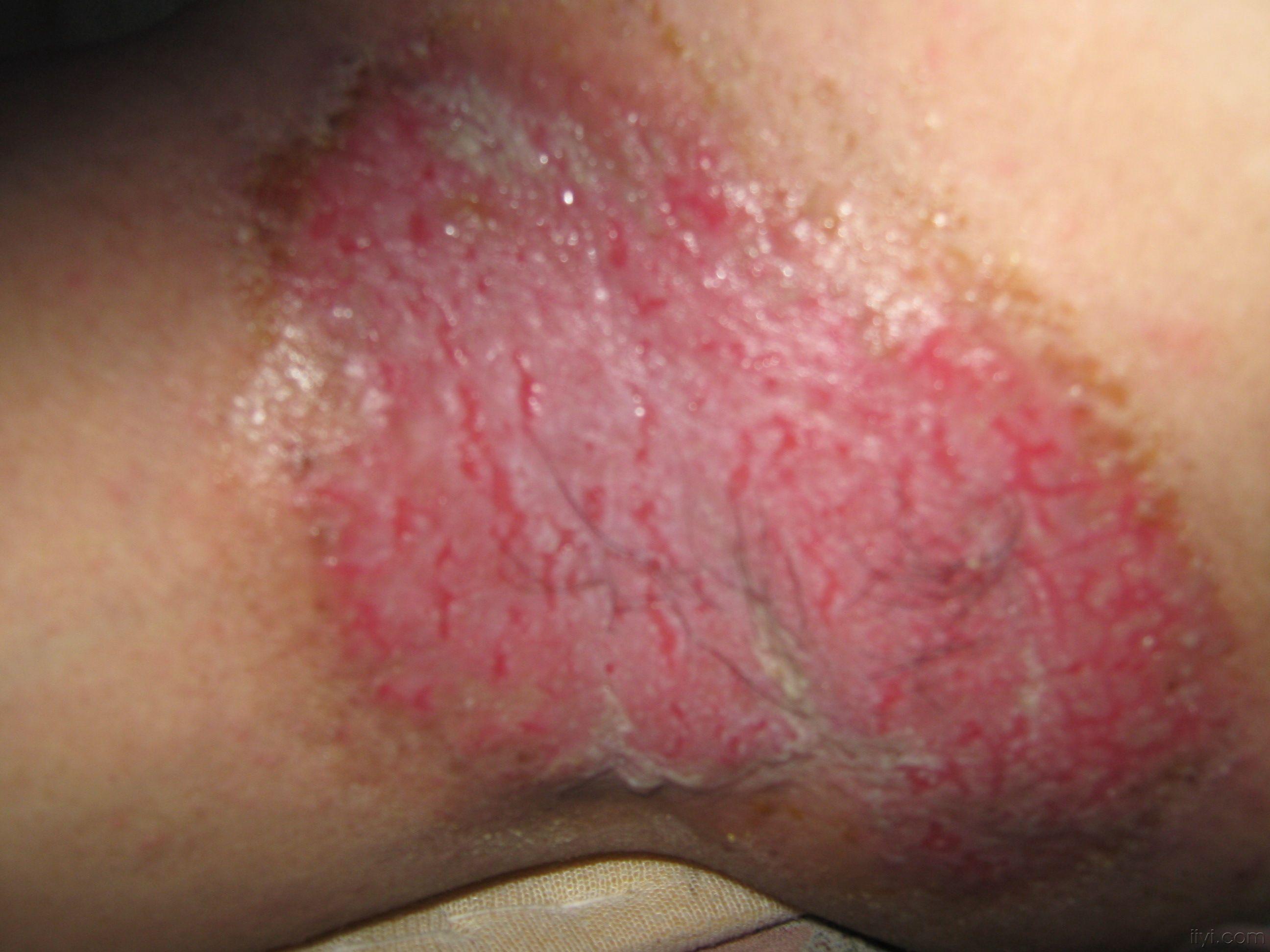 皮肤念珠菌的症状图片图片