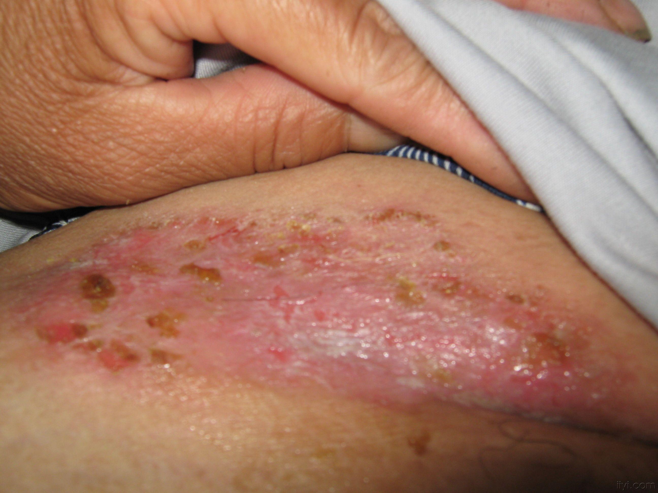 链球菌感染性皮疹图片图片
