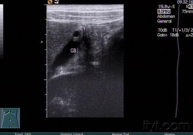 贴图超声诊断胆囊壁囊肿声像图