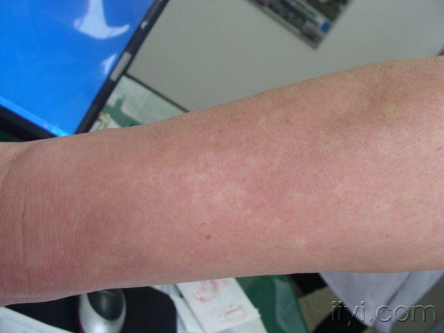 典型病例marshallwhite综合征