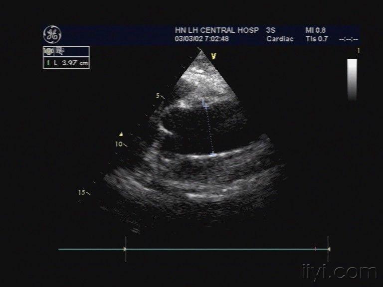 主动脉夹层iii型 超声医学讨论版 爱爱医医学论坛
