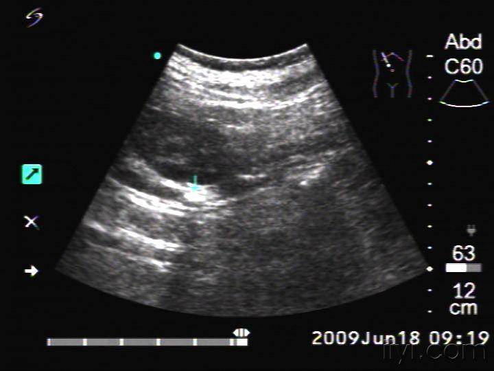 双侧输尿管结石 超声医学讨论版 爱爱医医学论坛