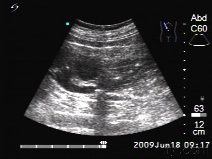 静脉石超声图片