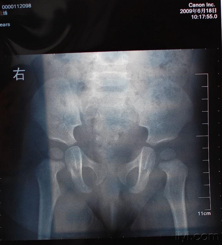 11个月的宝宝右侧股骨与骨盆间隙稍大该怎么办