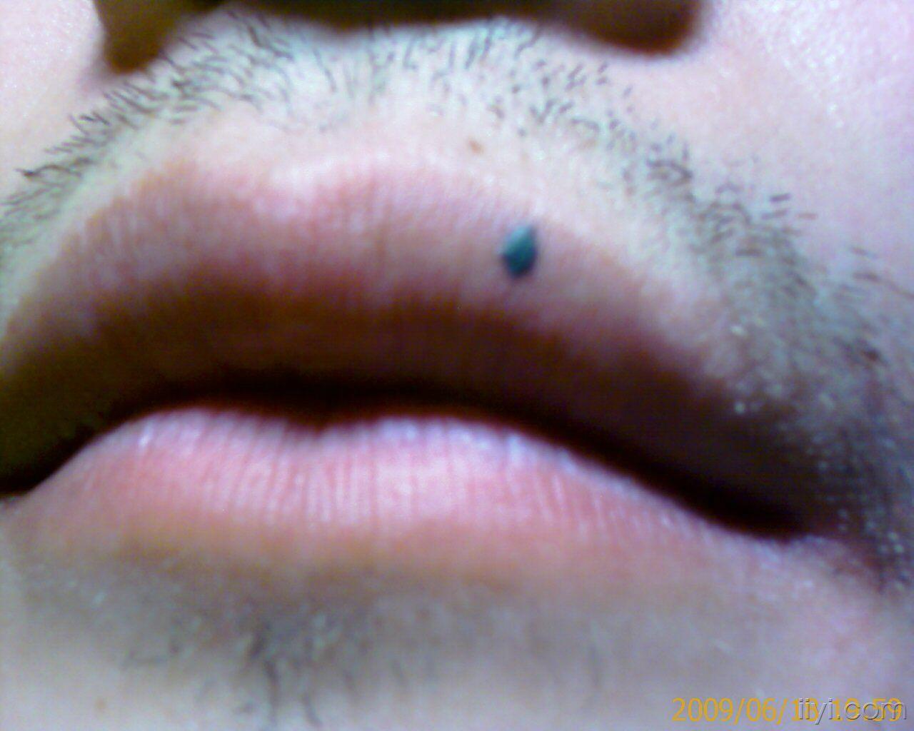 嘴唇上的黑色素瘤图片图片