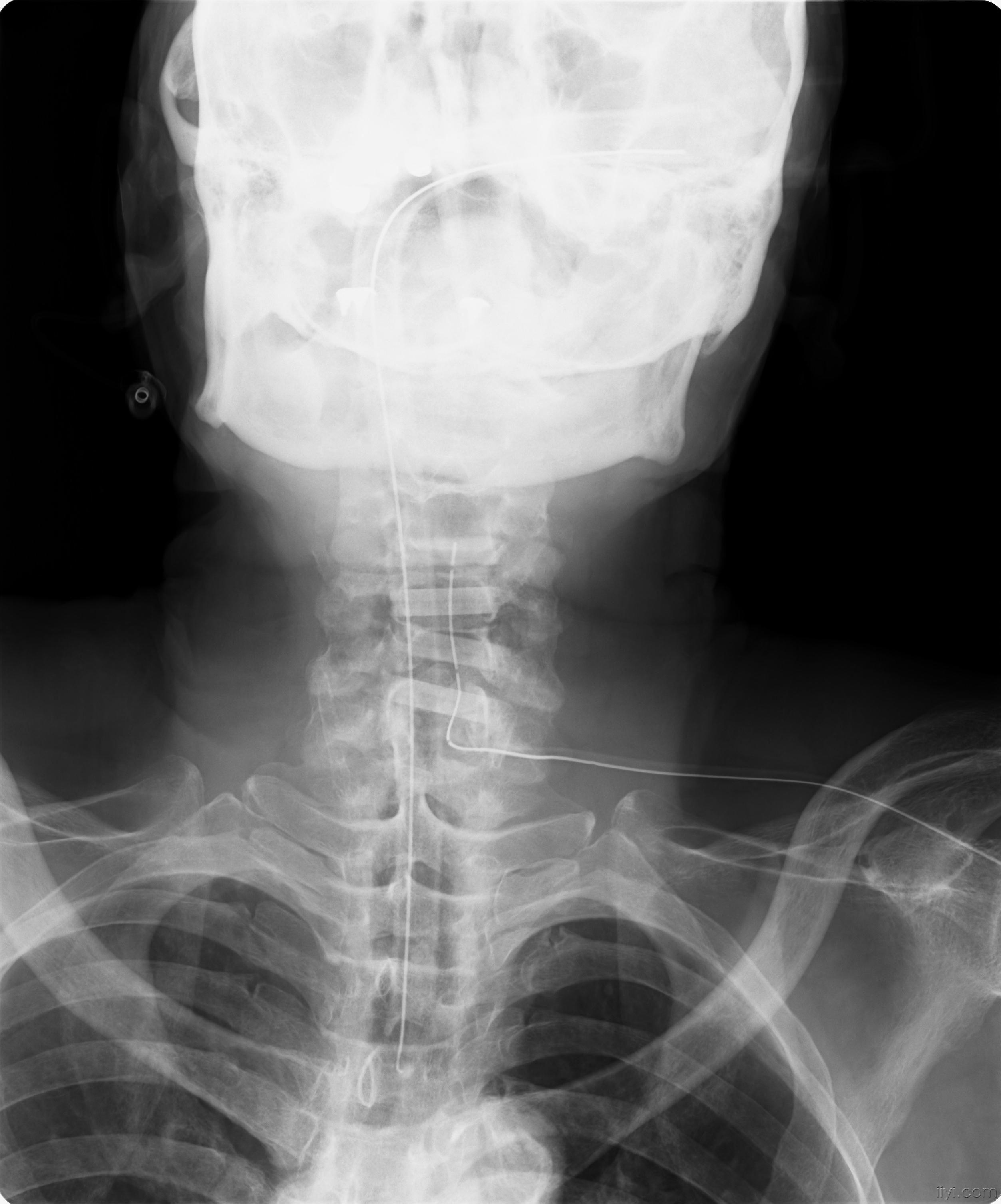 人工骨spacer运用治疗颈椎椎管狭窄症一例