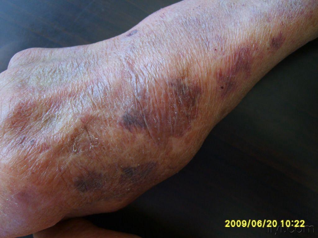 典型病例老年性紫癜