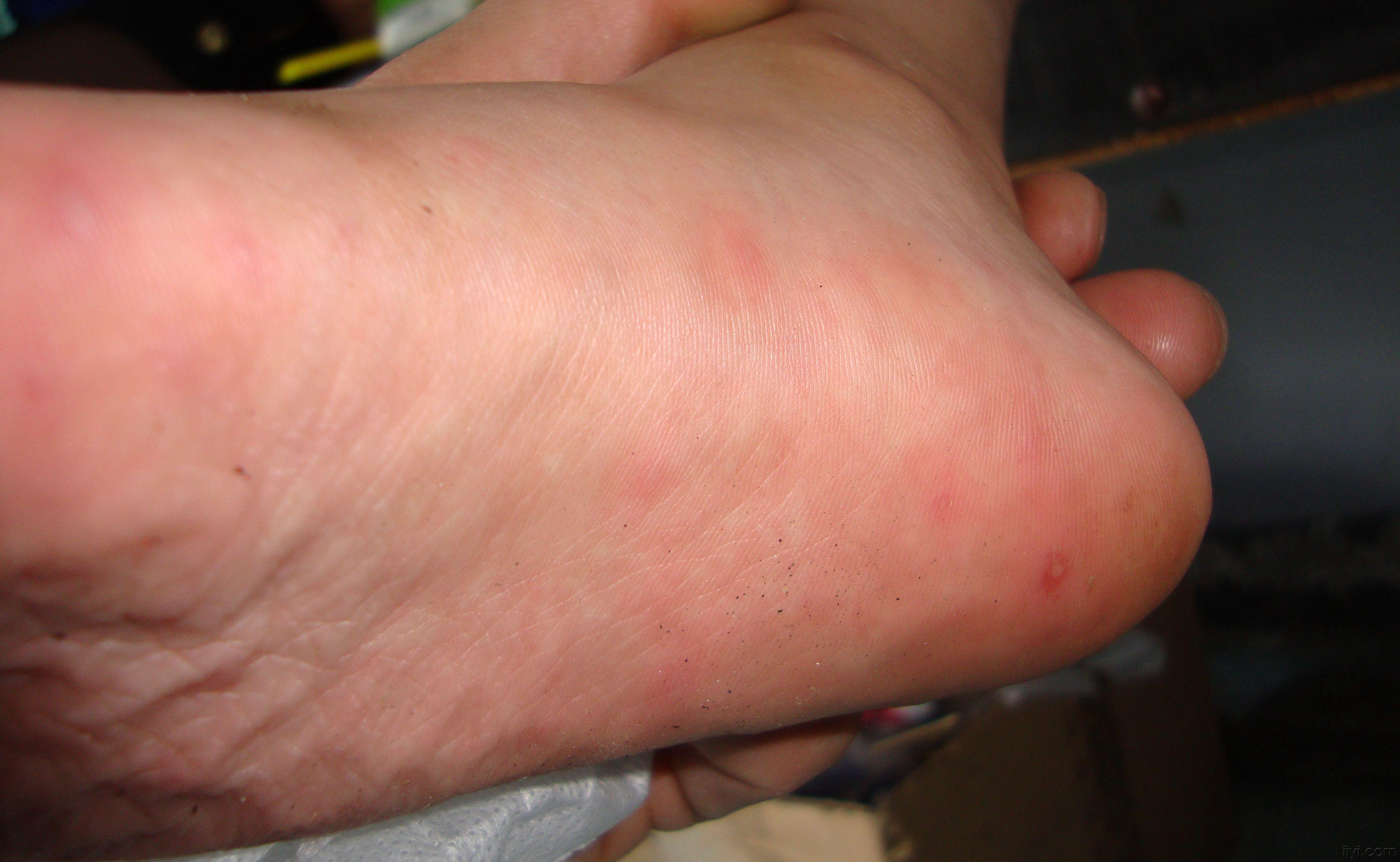 手足口病初期症状图片图片