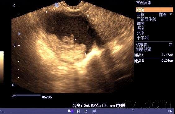 粘液性囊腺瘤超声图片