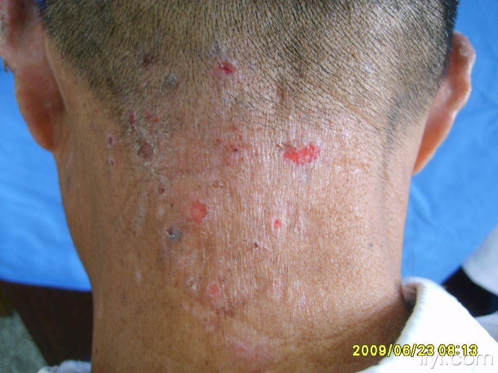 皮肤及性传播疾病讨论版 - 爱爱医医学论坛