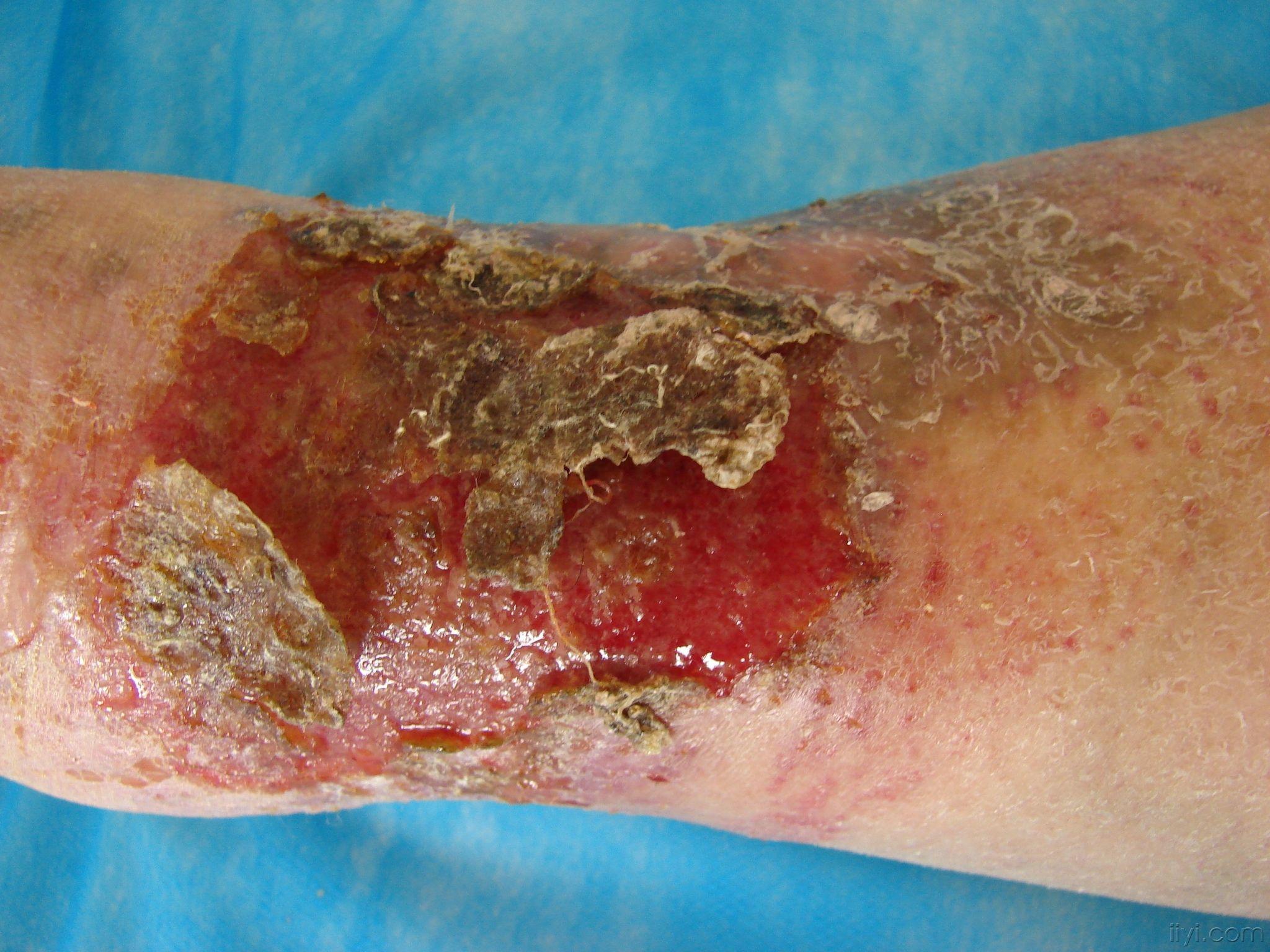 皮肤病淤积性湿疹