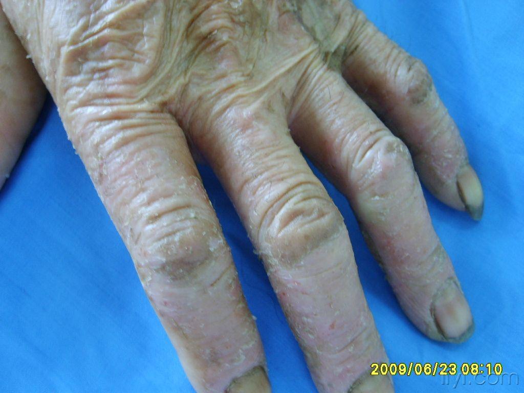 光敏性湿疹? - 皮肤及性传播疾病讨论版 - 爱爱医医学论坛