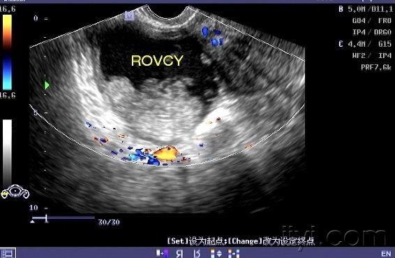 粘液性囊腺瘤超声图片