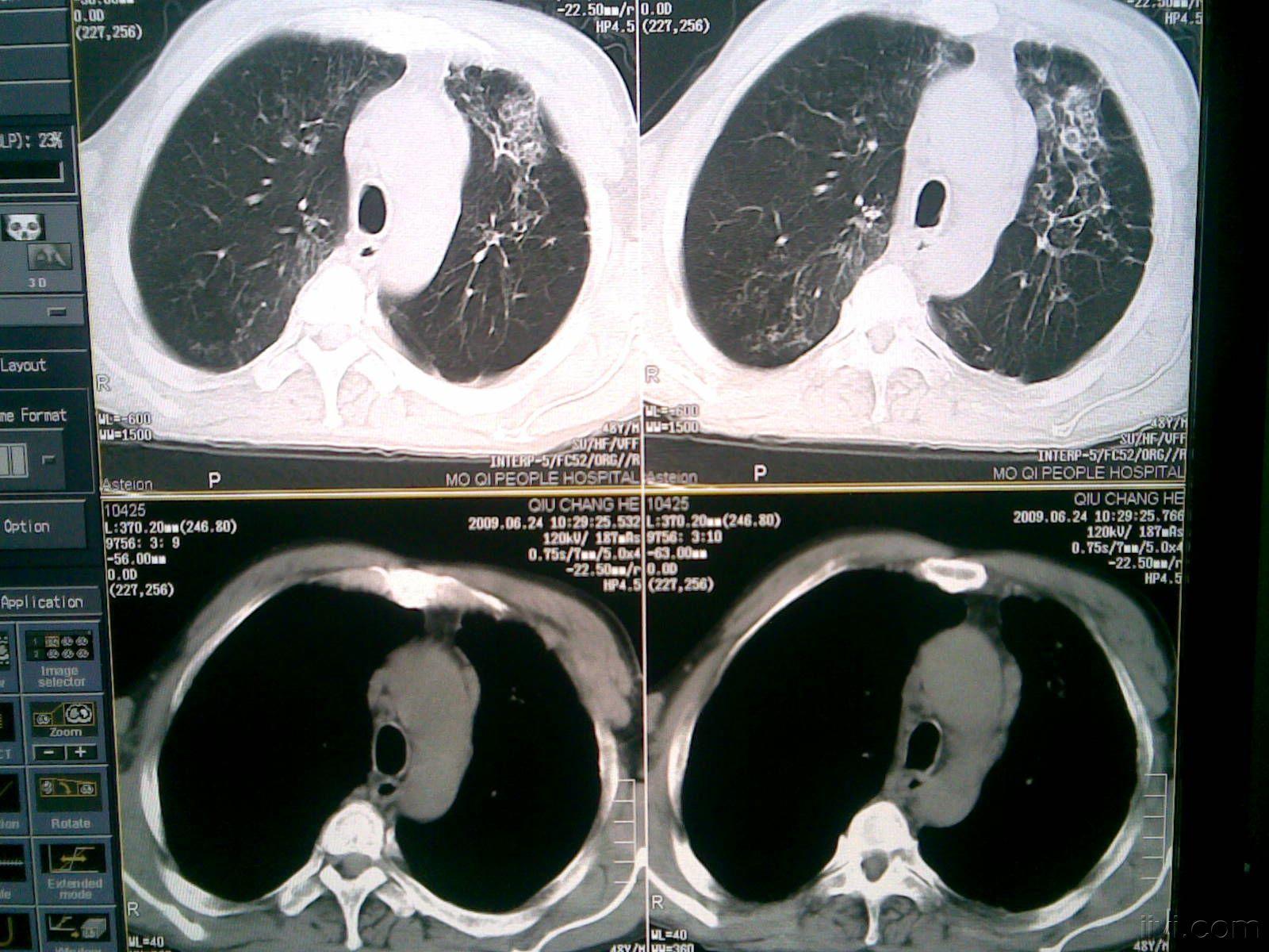 支擴結核肺泡癌腦內膿腫結核轉移瘤