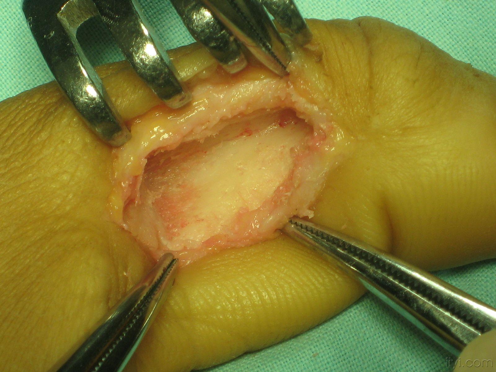 拇指近节骨肿瘤