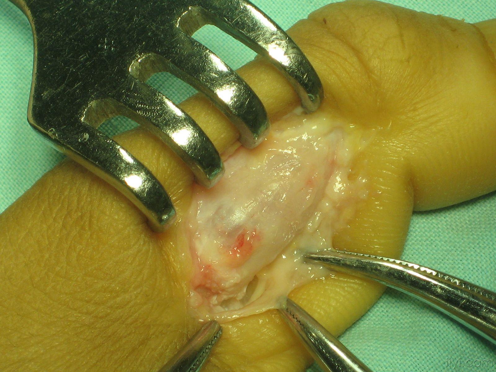 拇指近节骨肿瘤