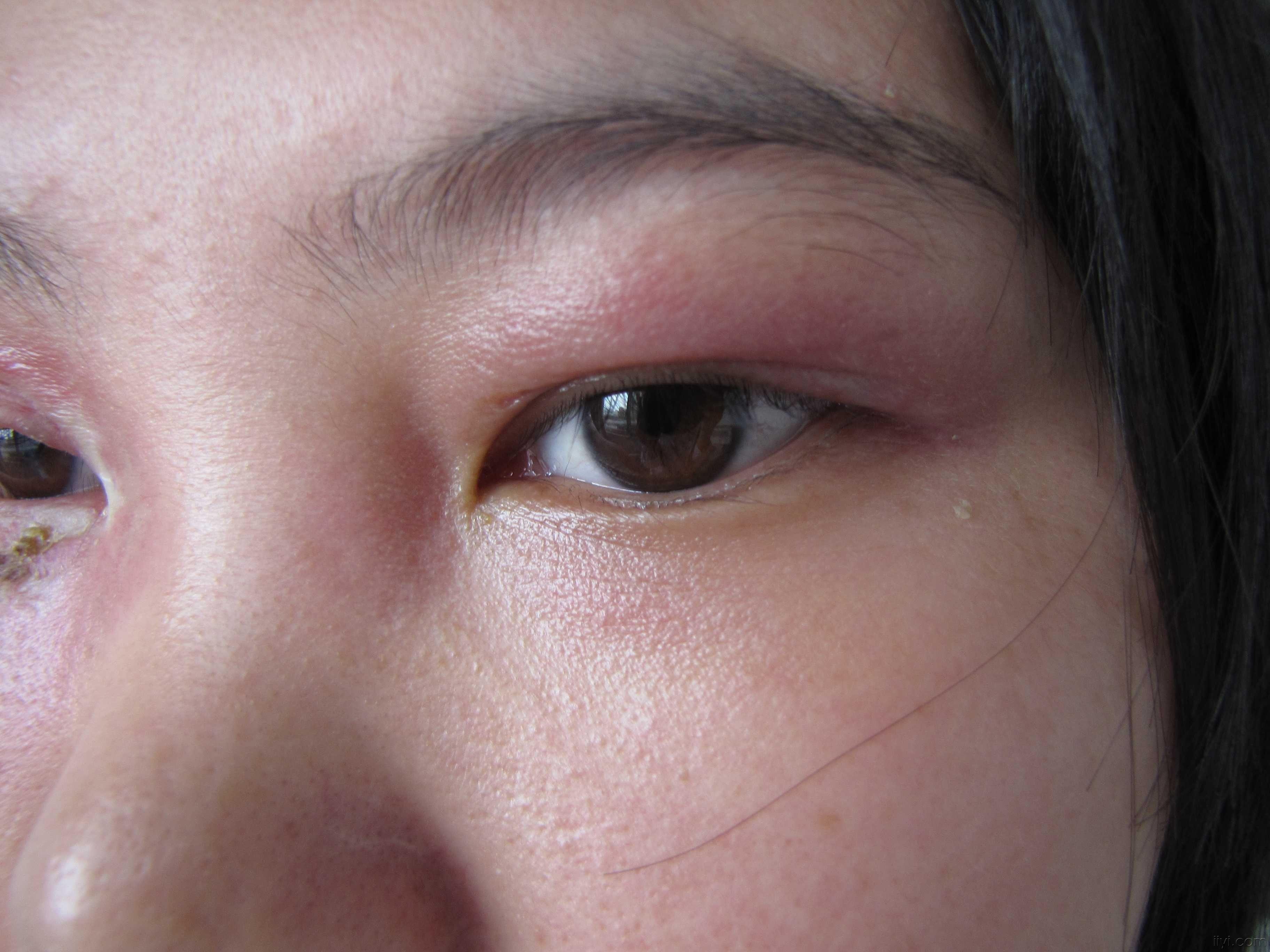 上眼皮睑腺炎图片图片