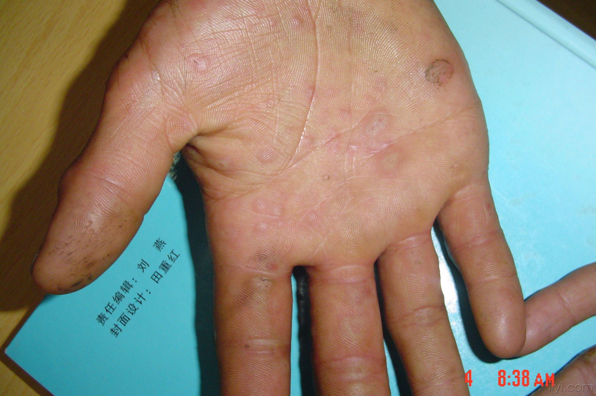 多形性红斑 - 皮肤及性传播疾病讨论版 - 爱爱医医学论坛