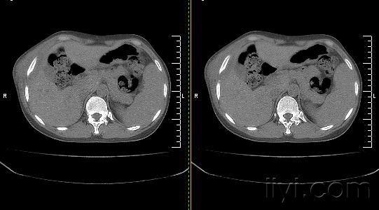 右下胸壁局部软组织肿胀突起
